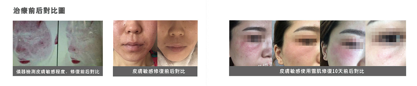 雪肌抗敏儀